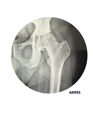 Radiografía mostrando cadera antes de reemplazo de cadera