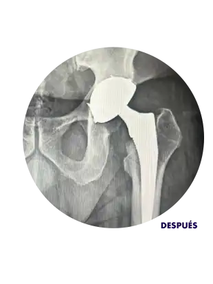 Radiografía mostrando cadera después de reemplazo de cadera