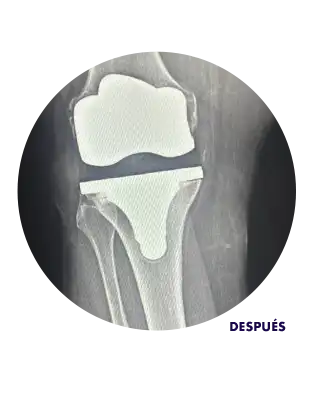 Radiografía mostrando rodilla después de reemplazo de rodilla