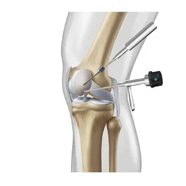 Cómo se realiza la artroscopia de rodilla