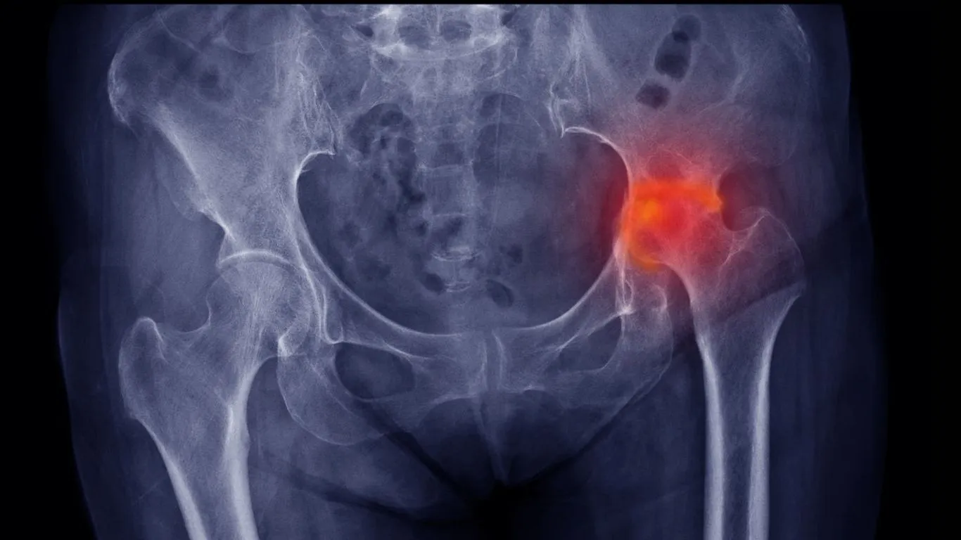 X-Ray of an Avascular Necrosis of the Hip (AVN)