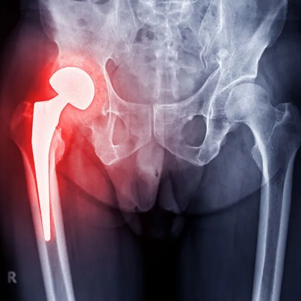 Hip X Ray that uses hip specialist