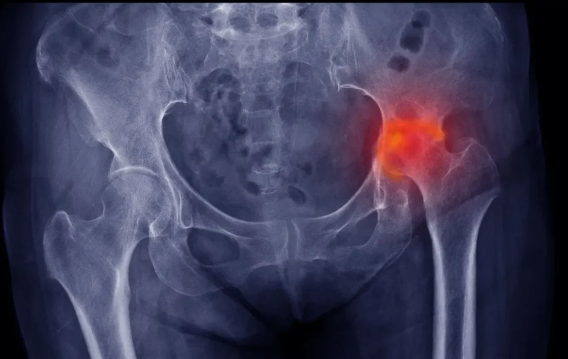 Necrosis Avascular de la Cabeza Femoral: Entendiendo el “Infarto” del Hueso