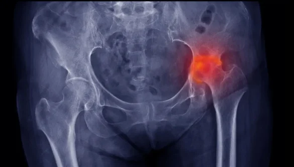 Necrosis Avascular de la Cabeza Femoral: Entendiendo el “Infarto” del Hueso