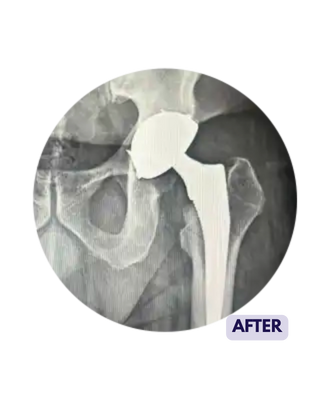 X Ray after hip replacement