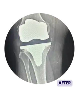 X Ray after knee replacement surgery