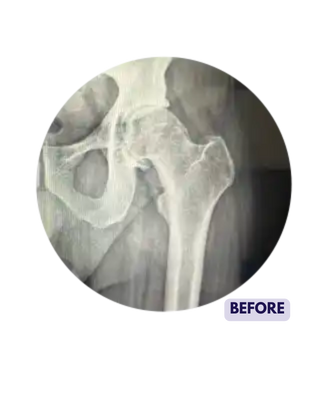 X Ray before hip replacement