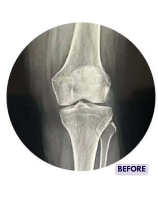 X Ray before knee replacement surgery