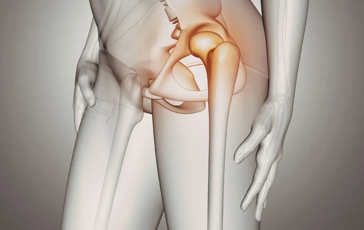 Displasia Acetabular: La Causa Oculta de tu Dolor Crónico de Cadera