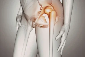 Displasia Acetabular: La Causa Oculta de tu Dolor Crónico de Cadera