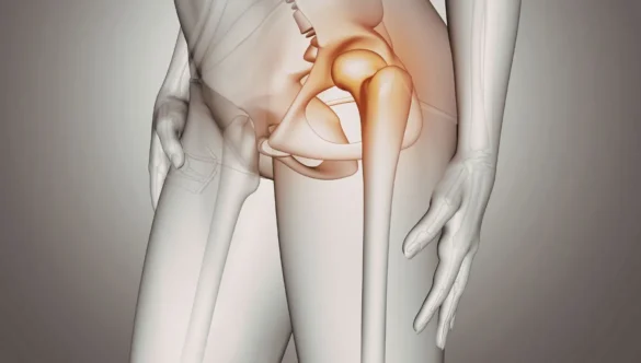 Displasia Acetabular: La Causa Oculta de tu Dolor Crónico de Cadera