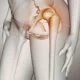 Displasia Acetabular: La Causa Oculta de tu Dolor Crónico de Cadera